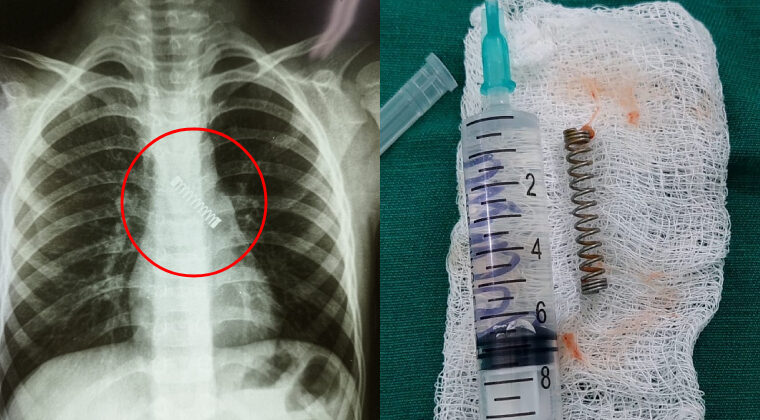 Tosía sin parar desde hace 3 meses: tenía un resorte en el bronquio
