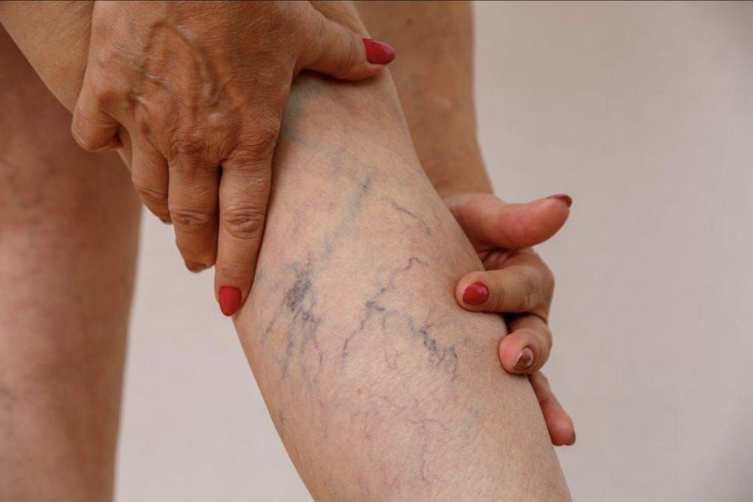 Cómo eliminar las famosas arañitas de las piernas