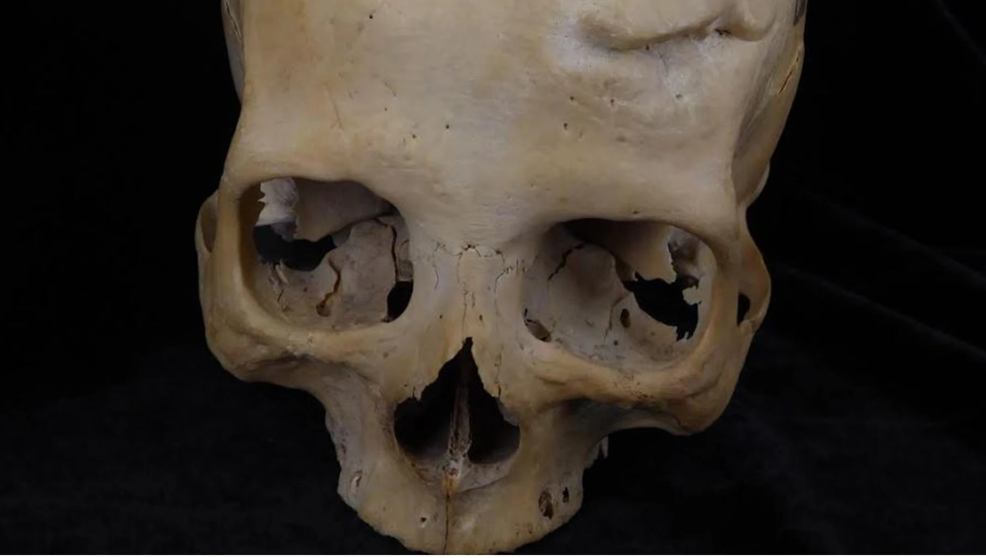 Un joven de 30 años del Antiguo Egipto, primer paciente operado de cáncer hace 4.500 años